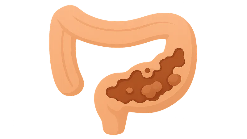 Necrotizing enterocolitis