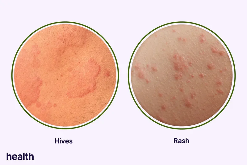 Delayed cutaneous reactions to contrast media: maculopapular rash and urticaria