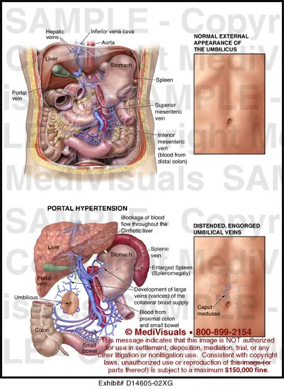 Portal Hypertension and Caput Medusae