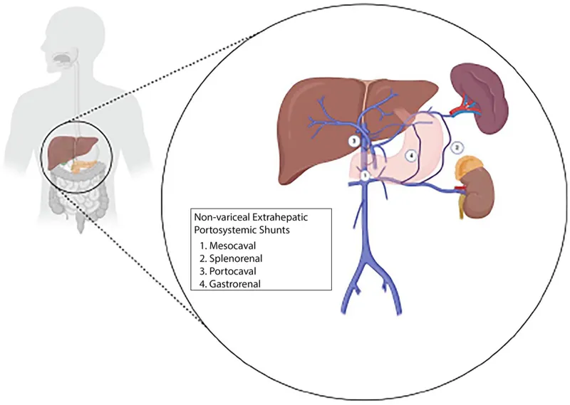Non-variceal Extrahepatic Portosystemic Shunts Diagram