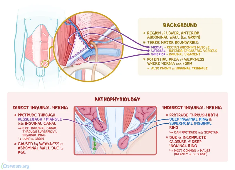 Inguinal Canal, Rings, Hesselbach's Triangle & Hernias