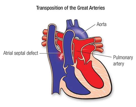 Transposition of Great Arteries with ASD