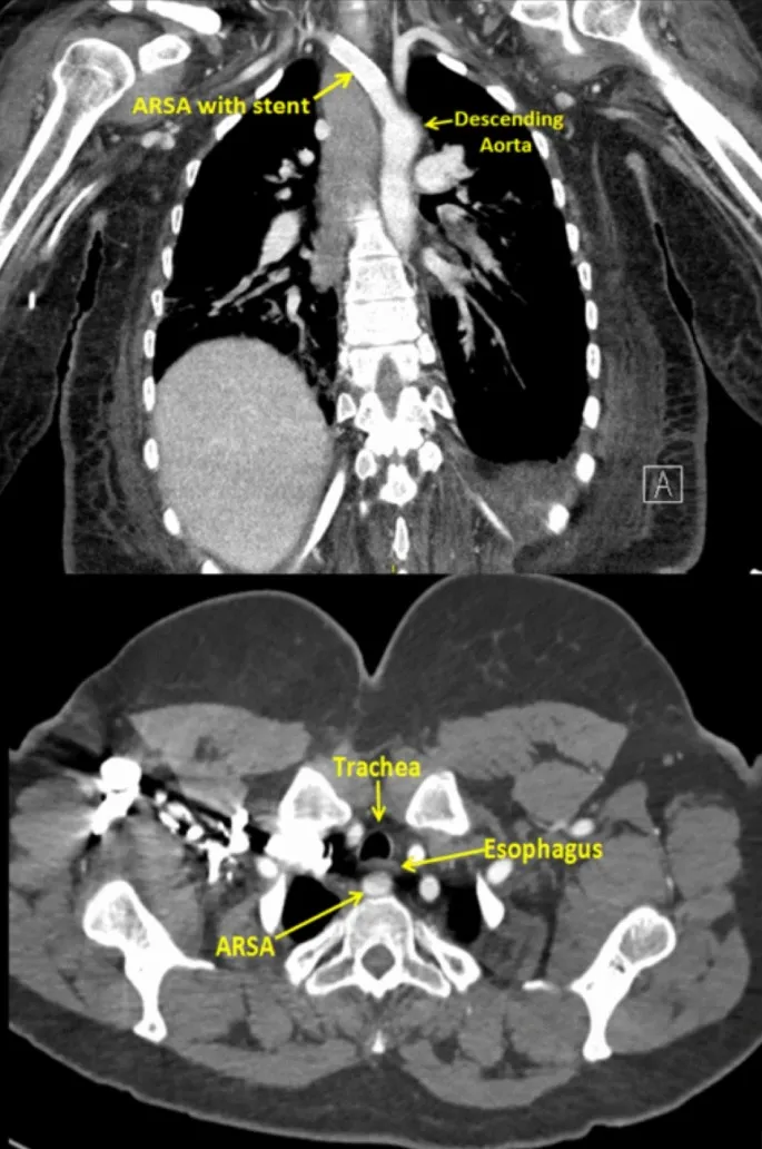 CT: Aberrant Right Subclavian Artery Compressing Esophagus