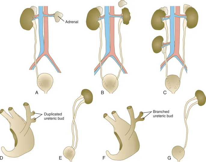 Congenital kidney and ureter anomalies
