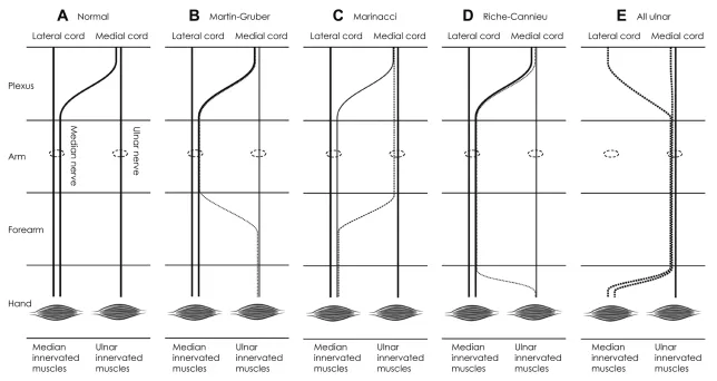 Median and ulnar nerve variations