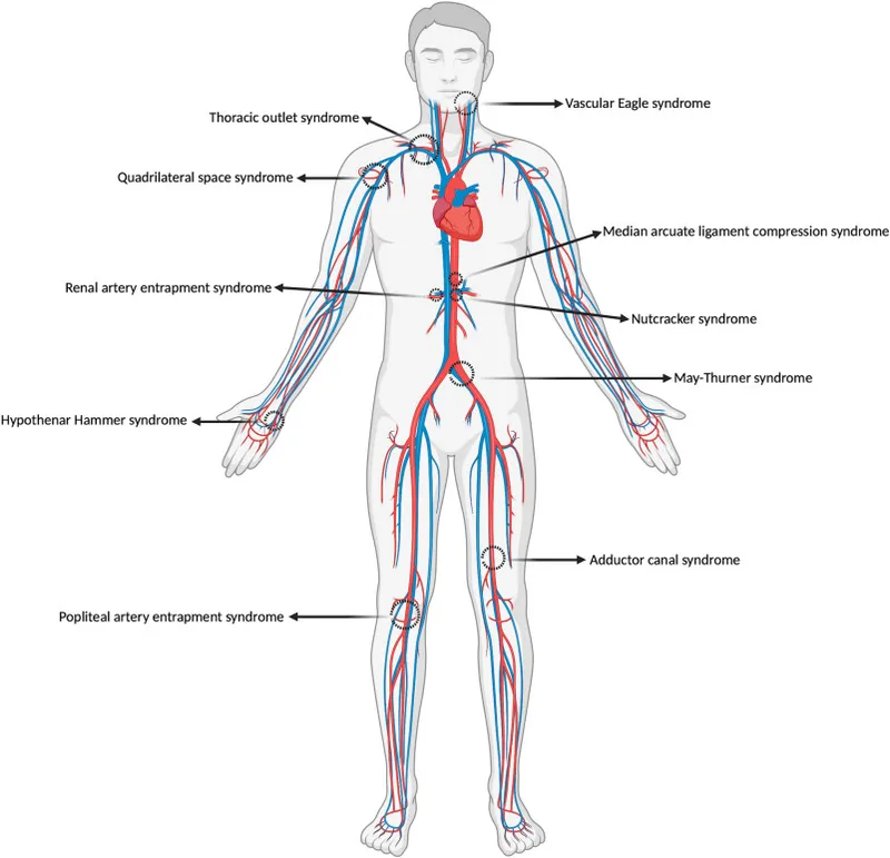 Vascular Compression Syndromes Diagram