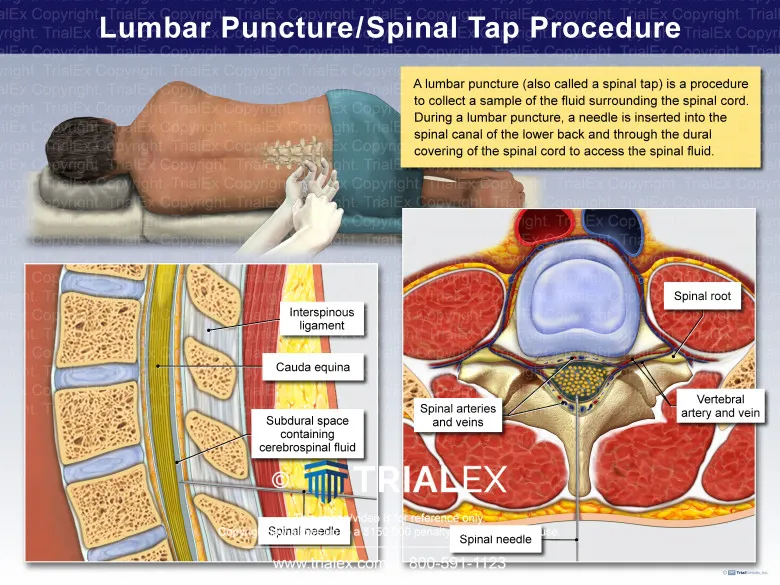 Sagittal view of lumbar spine for lumbar puncture
