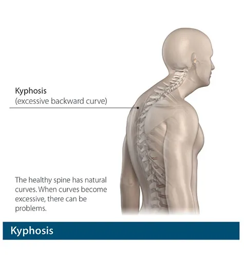 Kyphosis: Excessive backward spinal curve