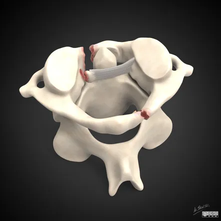 Jefferson fracture of C1 vertebra with ligament damage