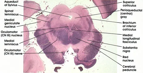 Midbrain cross-section with colliculi, nuclei, and peduncles