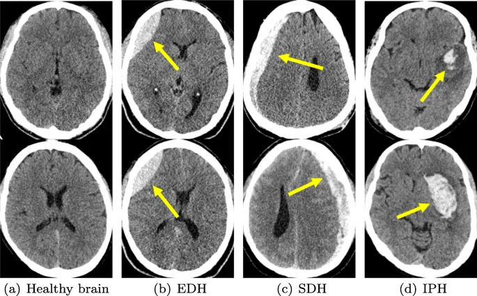 CT scan comparison of EDH, SDH, and IPH
