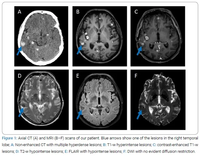 Neurocysticercosis on CT and MRI
