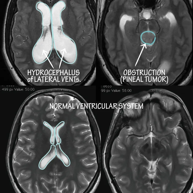 MRI: Hydrocephalus vs Normal Ventricular System