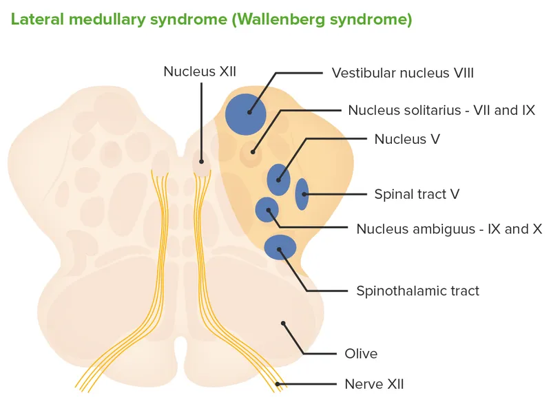 Lateral Medullary Syndrome (Wallenberg) cross-section