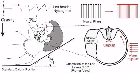 Caloric reflex test: warm irrigation and nystagmus