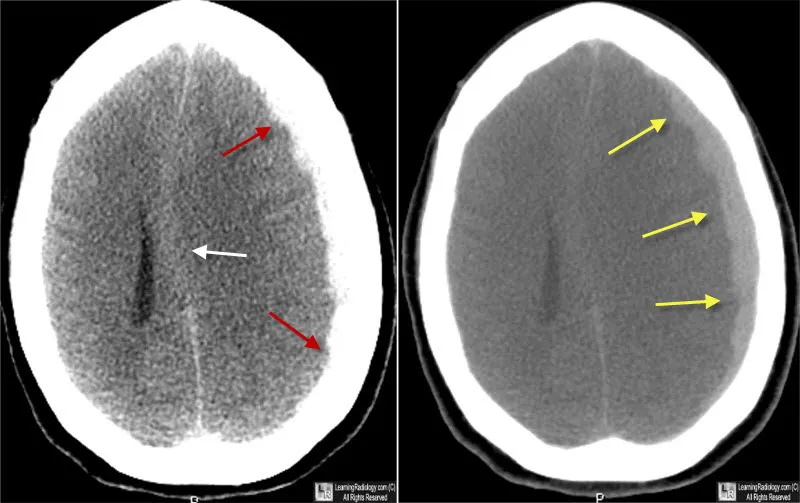 CT scan showing acute and chronic subdural hematoma