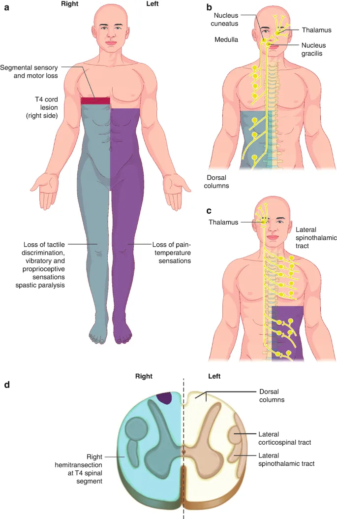 Brown-Séquard syndrome sensory and motor deficits