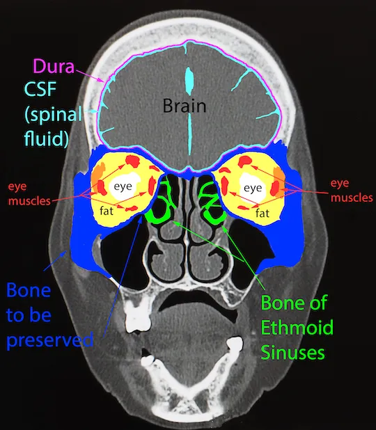 Coronal CT Head: Paranasal Sinuses and Orbits