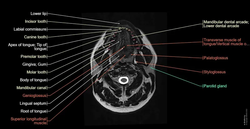 Axial MRI of oral cavity with labeled anatomical structures