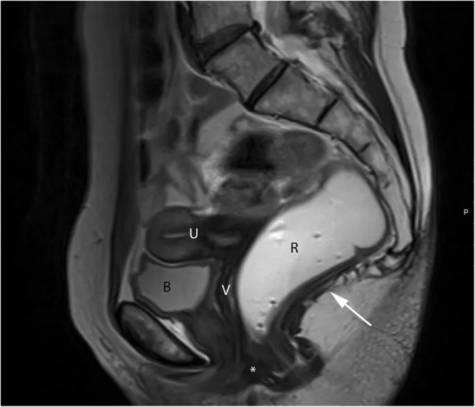 Sagittal MRI of female pelvis: bladder, uterus, rectum