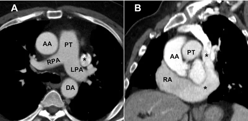 Axial & Sagittal CT: Thoracic Great Vessels
