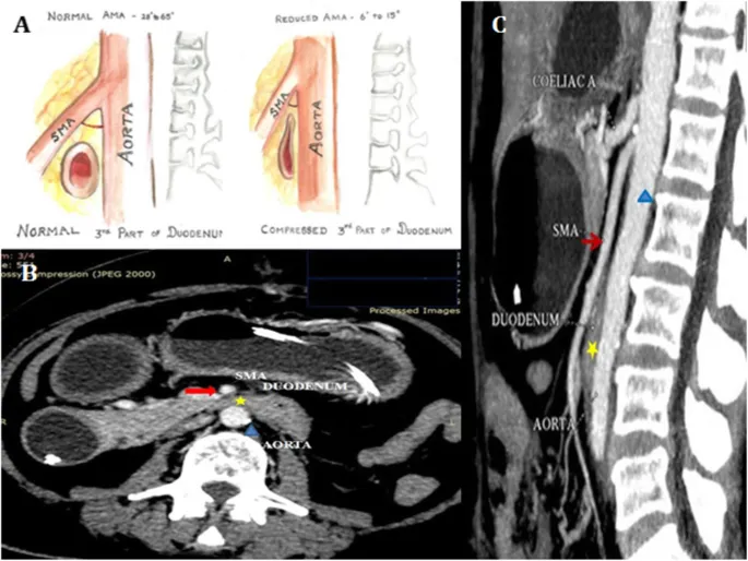 SMA Syndrome: Axial and Sagittal CT with Diagrams