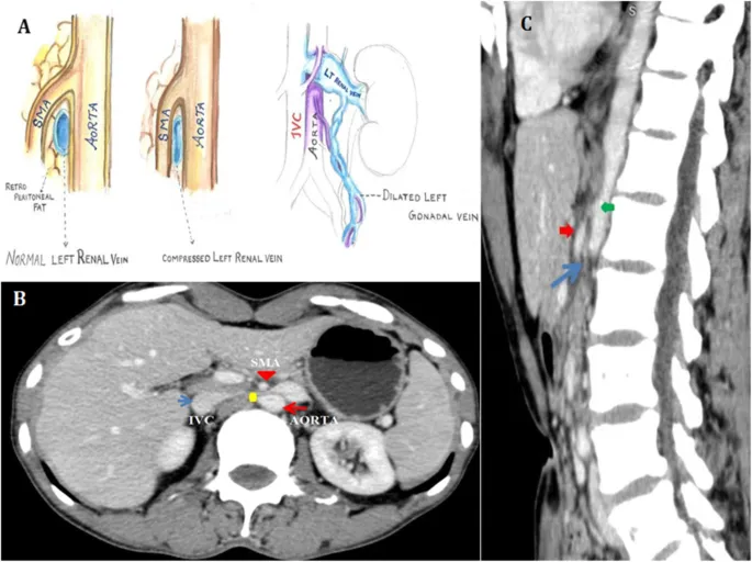 Nutcracker Syndrome: CT and diagrams