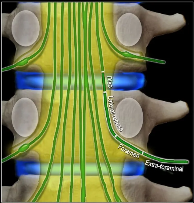 Spinal nerve root compression by herniated disc