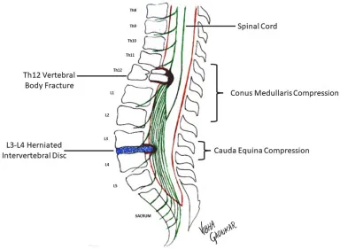 Conus Medullaris vs Cauda Equina Compression