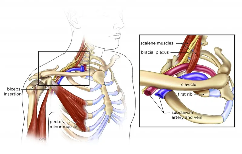 Thoracic Outlet Syndrome Compression Sites