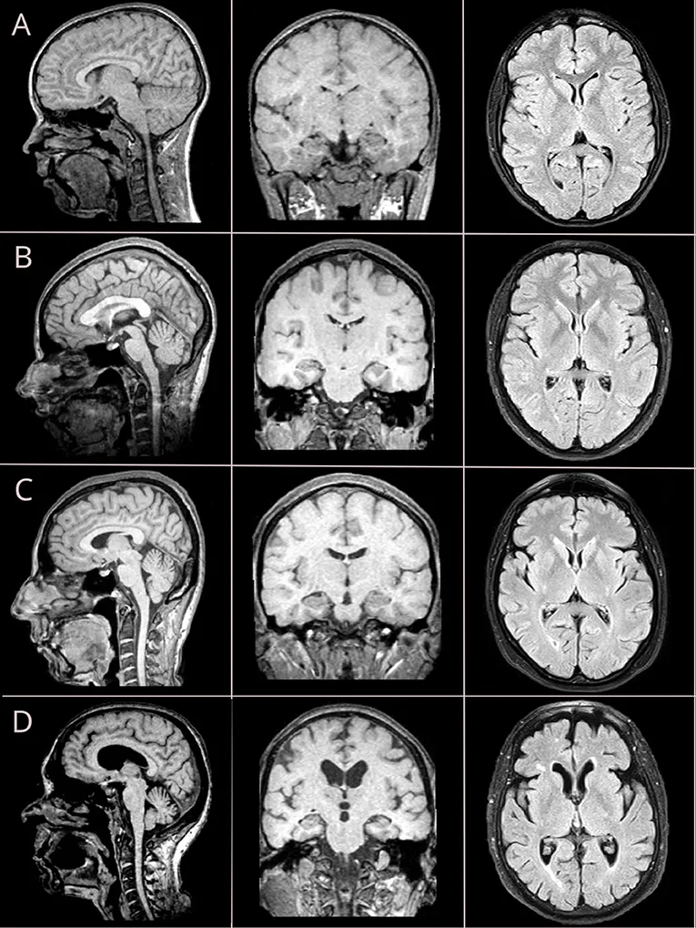 MRI comparison of young vs aged brain
