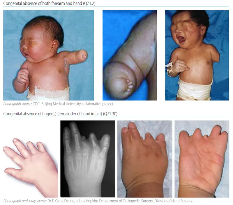Congenital limb abnormalities