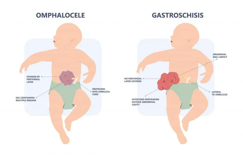 Omphalocele vs Gastroschisis Comparison