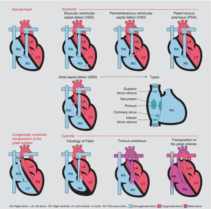 Common congenital heart defects diagram