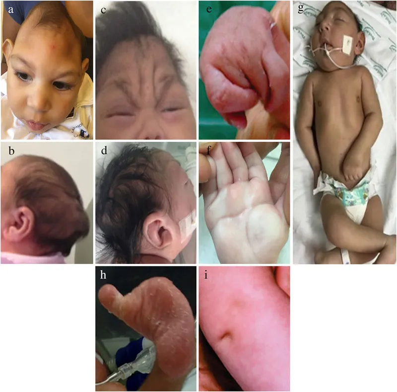 Fetal anomalies from teratogen exposure