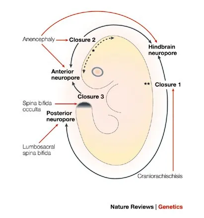 Neural tube closure and associated birth defects