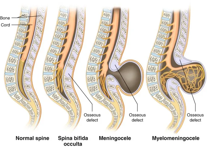 Spina Bifida Types: Occulta, Meningocele, Myelomeningocele