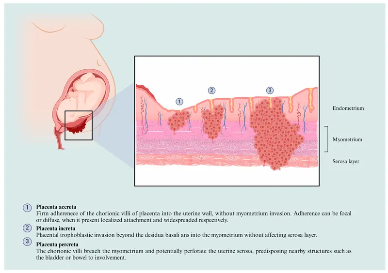 Placenta Accreta, Increta, and Percreta Invasion Depths