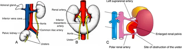 Urogenital system development anomalies