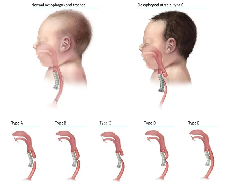 Types of Oesophageal Atresia