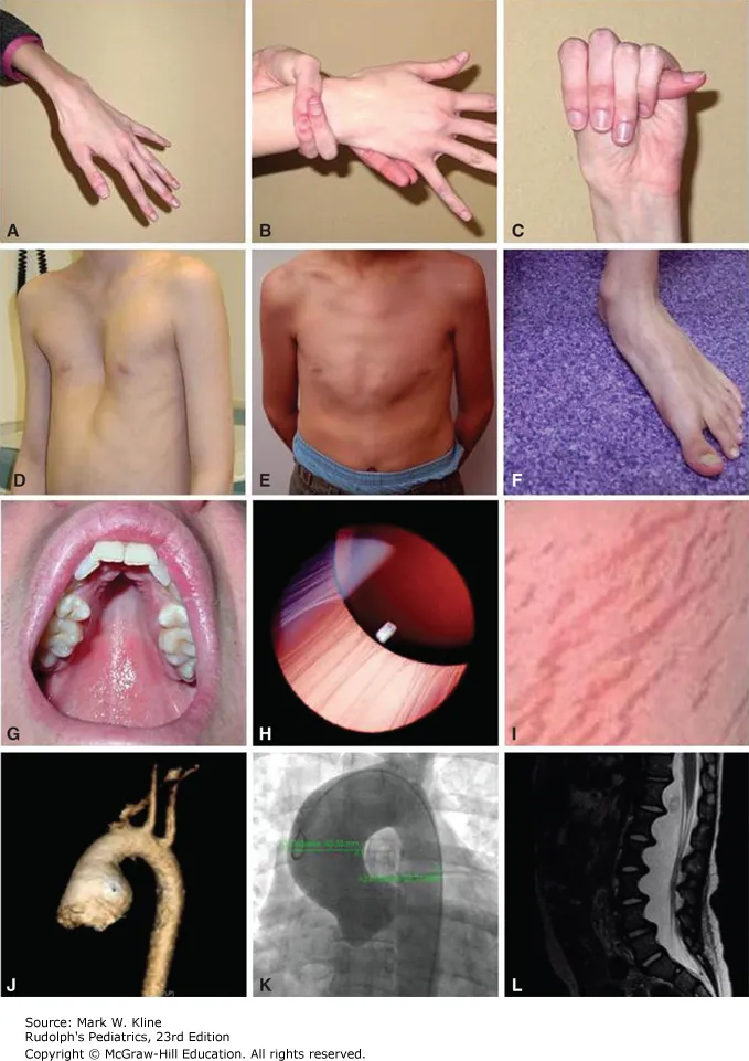 Clinical manifestations of Marfan syndrome