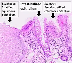 Barrett's Esophagus: Intestinal Metaplasia