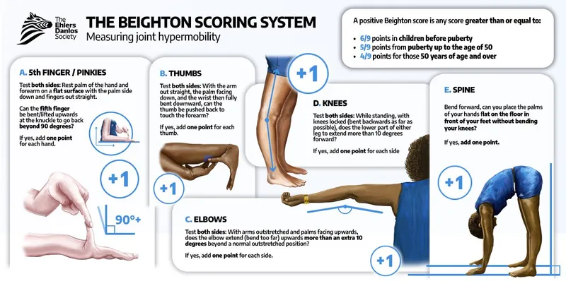 Beighton Scoring System for Joint Hypermobility