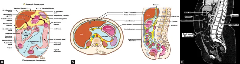Abdominopelvic fluid collection spaces and CT correlation