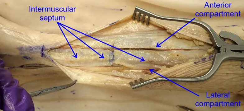 Leg Fascial Compartments and Intermuscular Septum