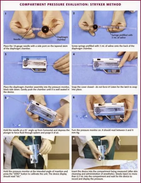 Stryker Method for Compartment Pressure Measurement