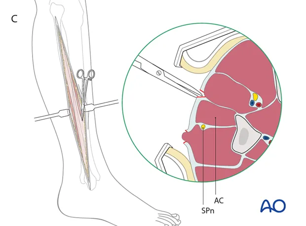 Leg Fasciotomy: Anterior and Lateral Compartment Release