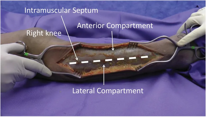 Surgical approach to leg fascial compartments