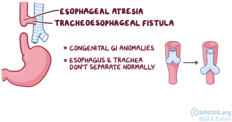Esophageal Atresia and Tracheoesophageal Fistula