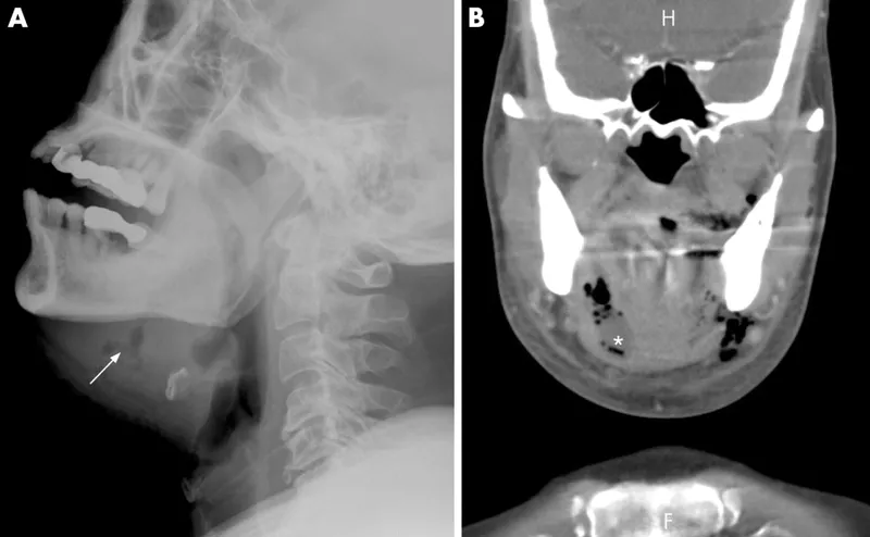 Ludwig's Angina: Lateral X-ray and Coronal CT
